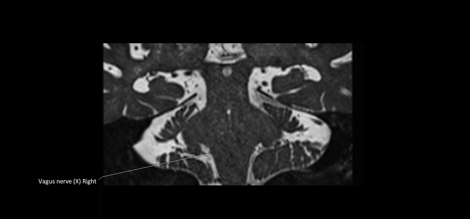 Cranial nerve cross sectional anatomy coronal 3T MRI image 49.webp